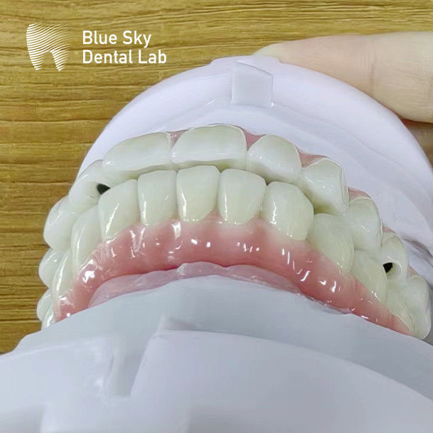 Blue Sky Implant Cases With Malo Frame Bridge Pure Titanium 0