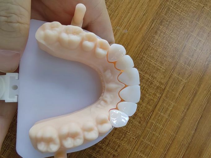 Highly Translucent Layered Zirconia Crowns Natural With Implant Crown 0