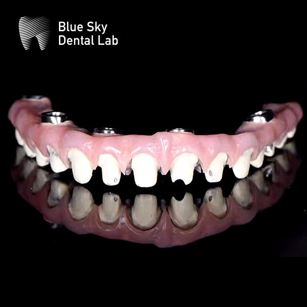 Customizable Pure Titanium Malo Bridge Dental Blue Sky Implant System 0