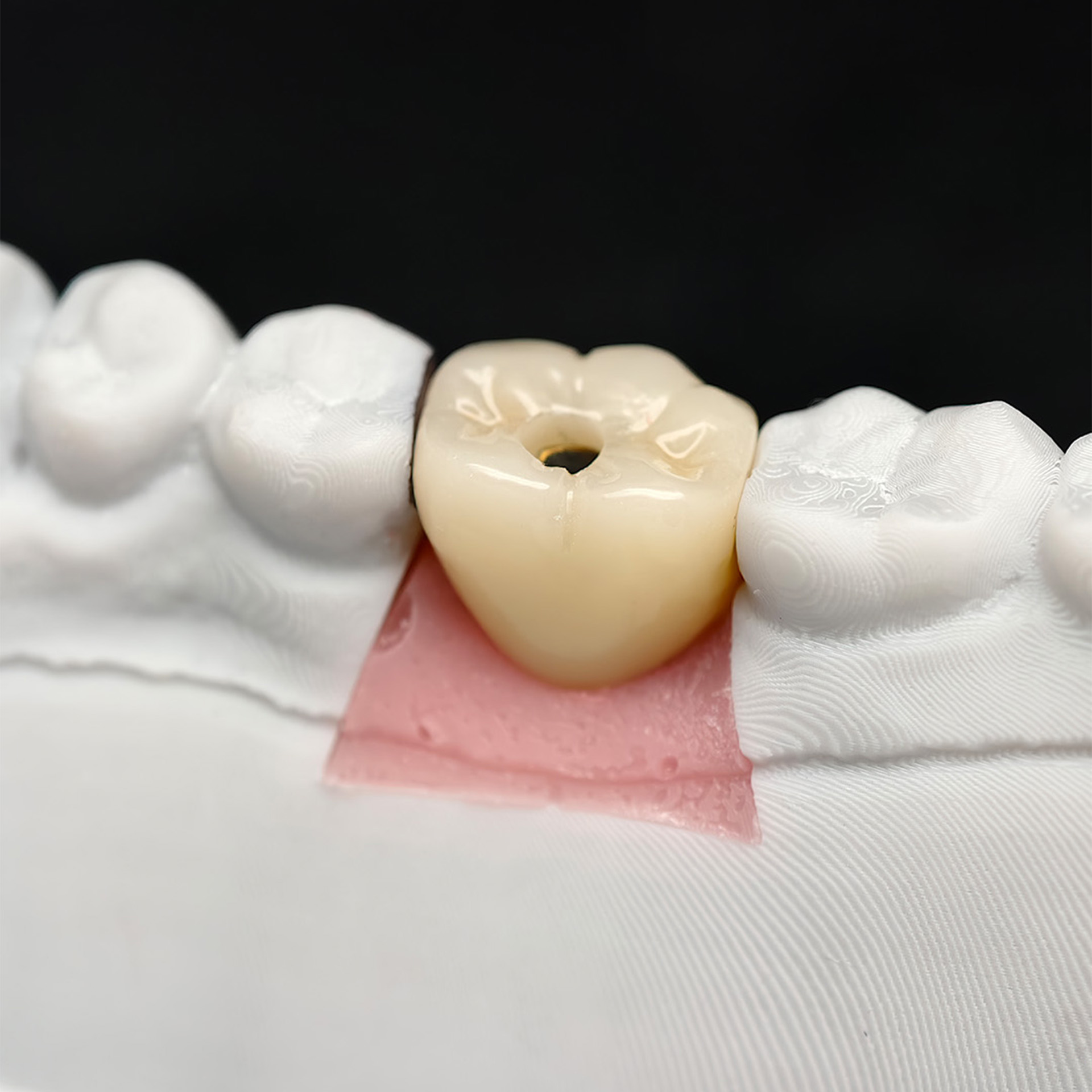 Custom Zirconia Implant Crown
