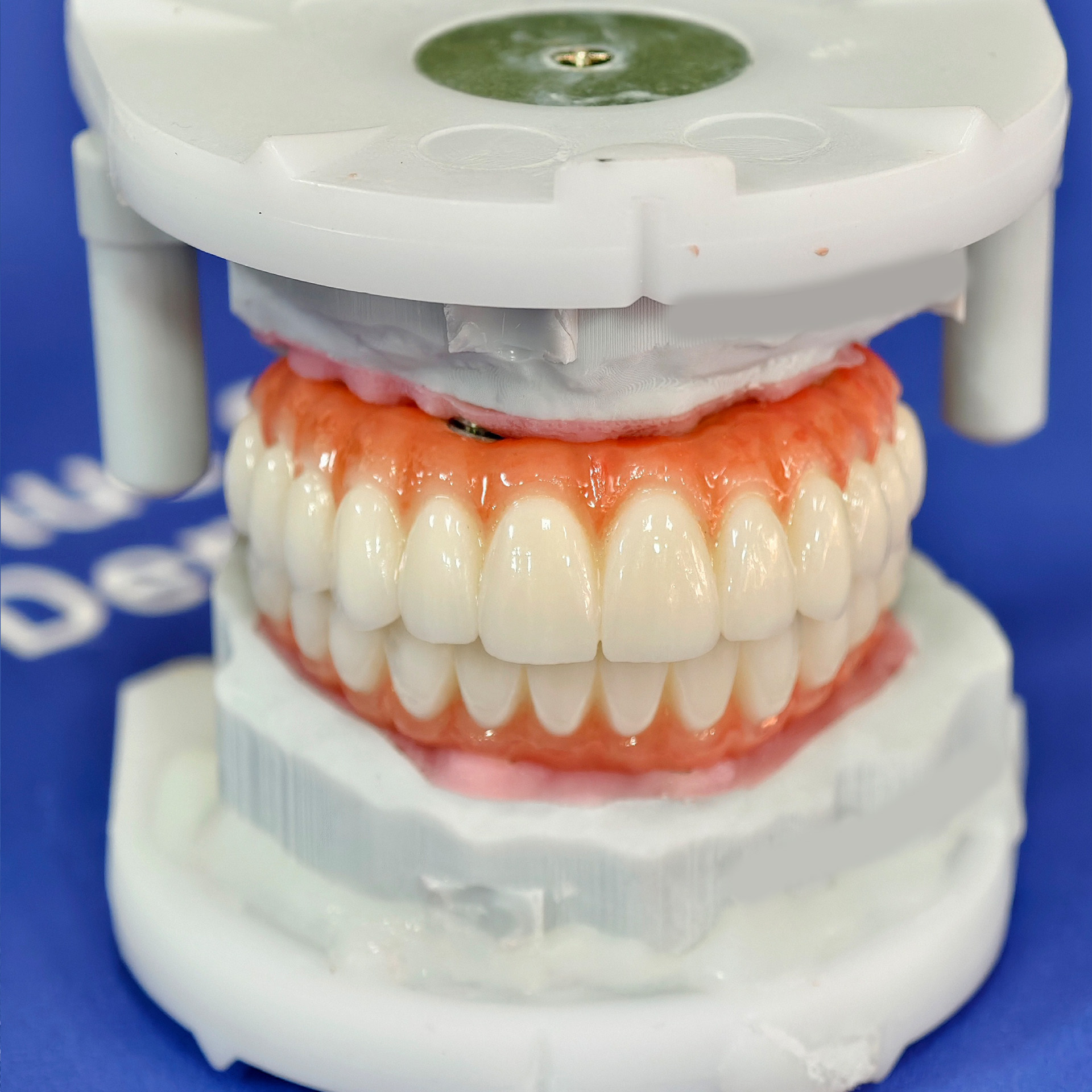 all on 4 zirconia bridge with 