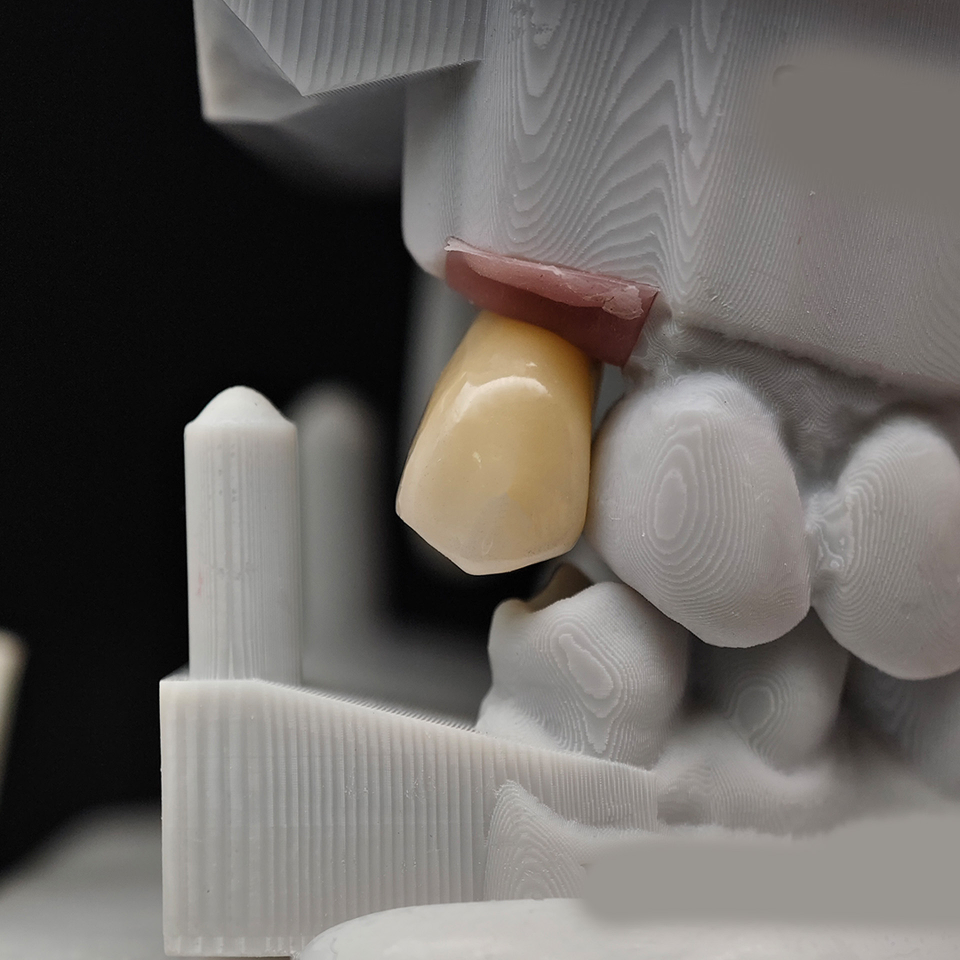 Custom Zirconia Implant Crown