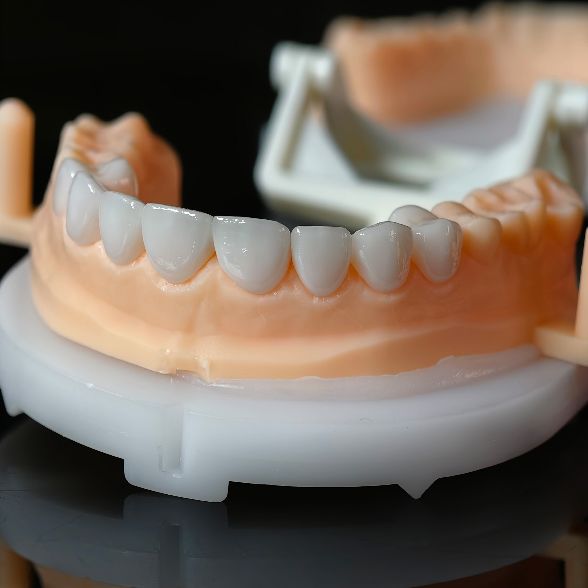 PFZ porcelain fused zirconia A