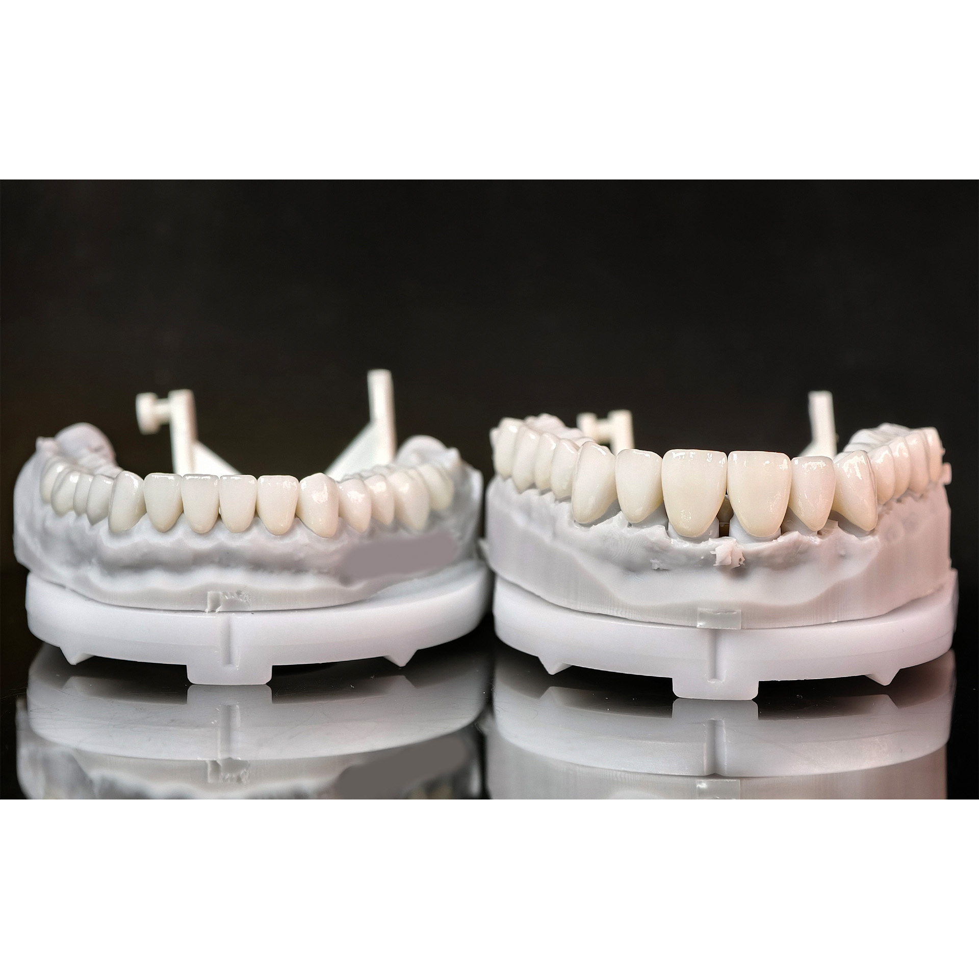 Ceramic Veneers and Crown with