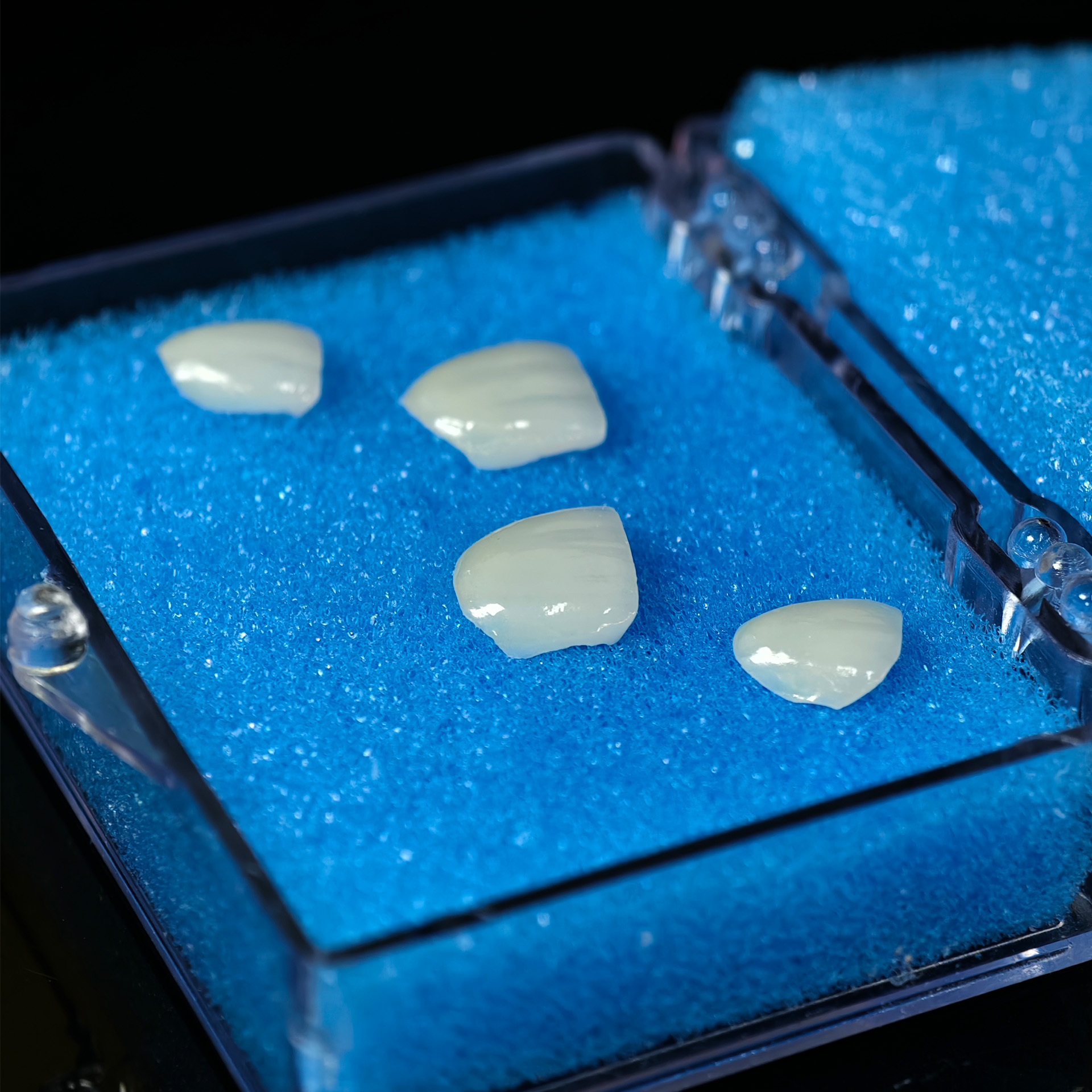 Ultra-thin emax veneer. High t