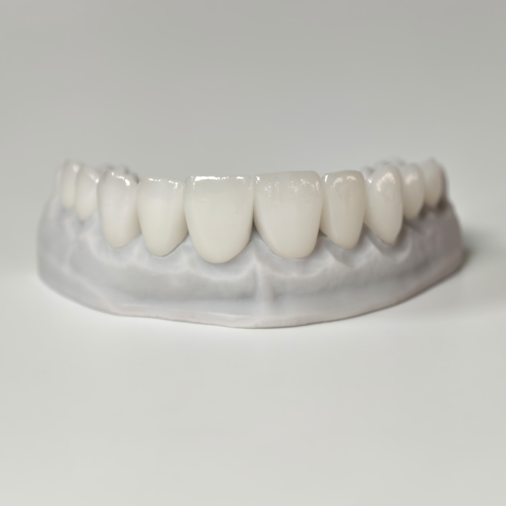 Ultra-thin emax veneer. High t
