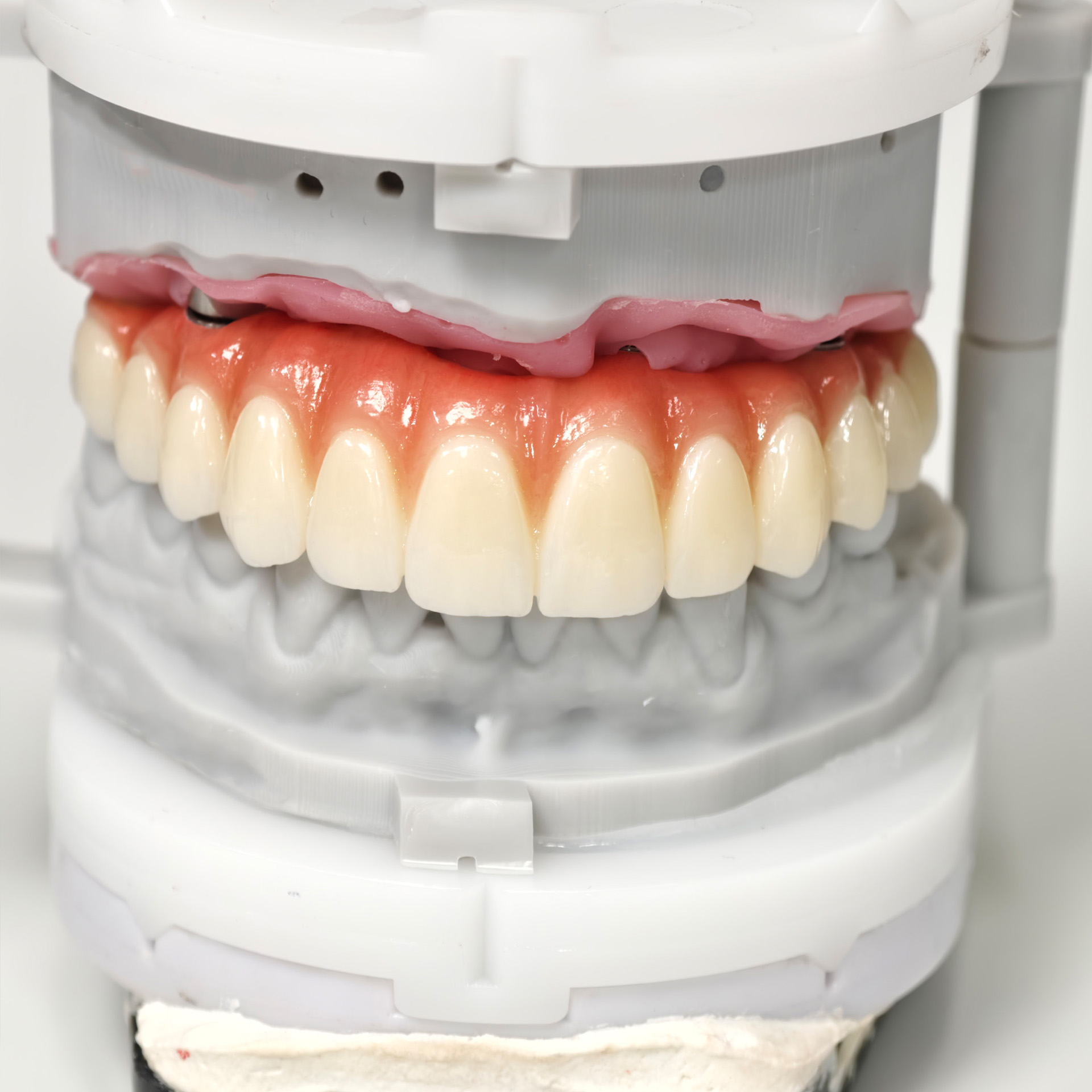 All on 6 zirconia bridge with Ti-base sc