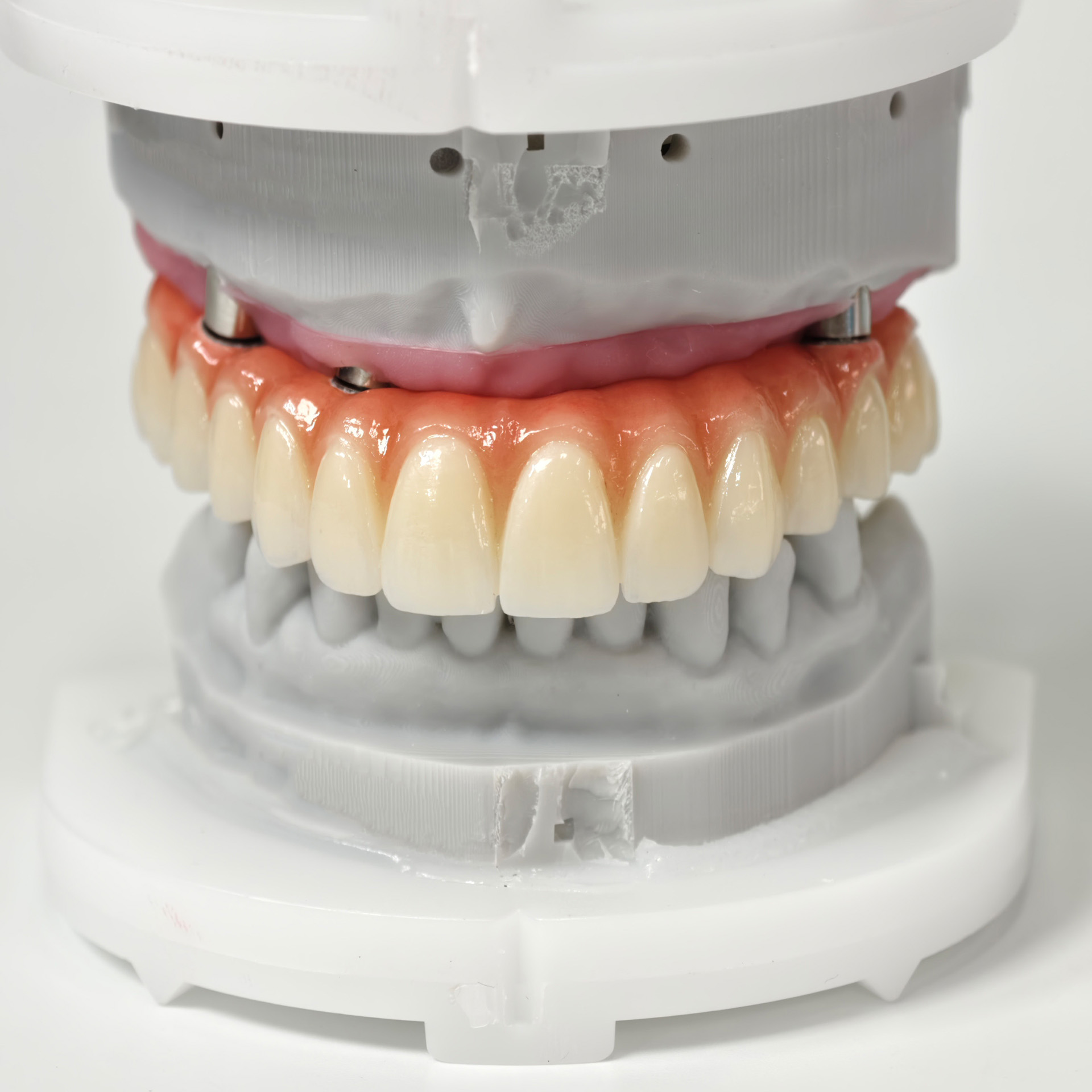 All on 5 zirconia bridge with 