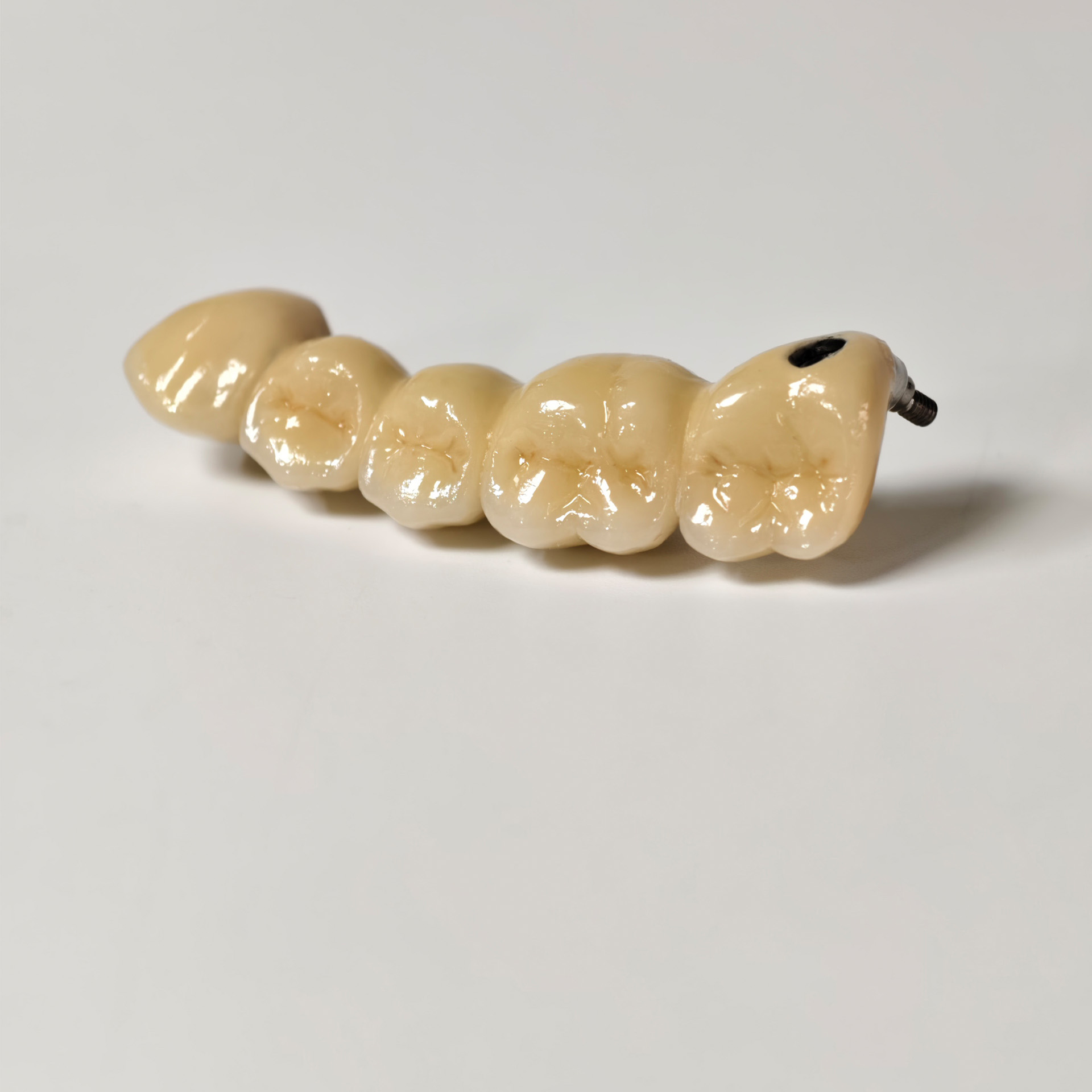 Implant-supported PFM single b