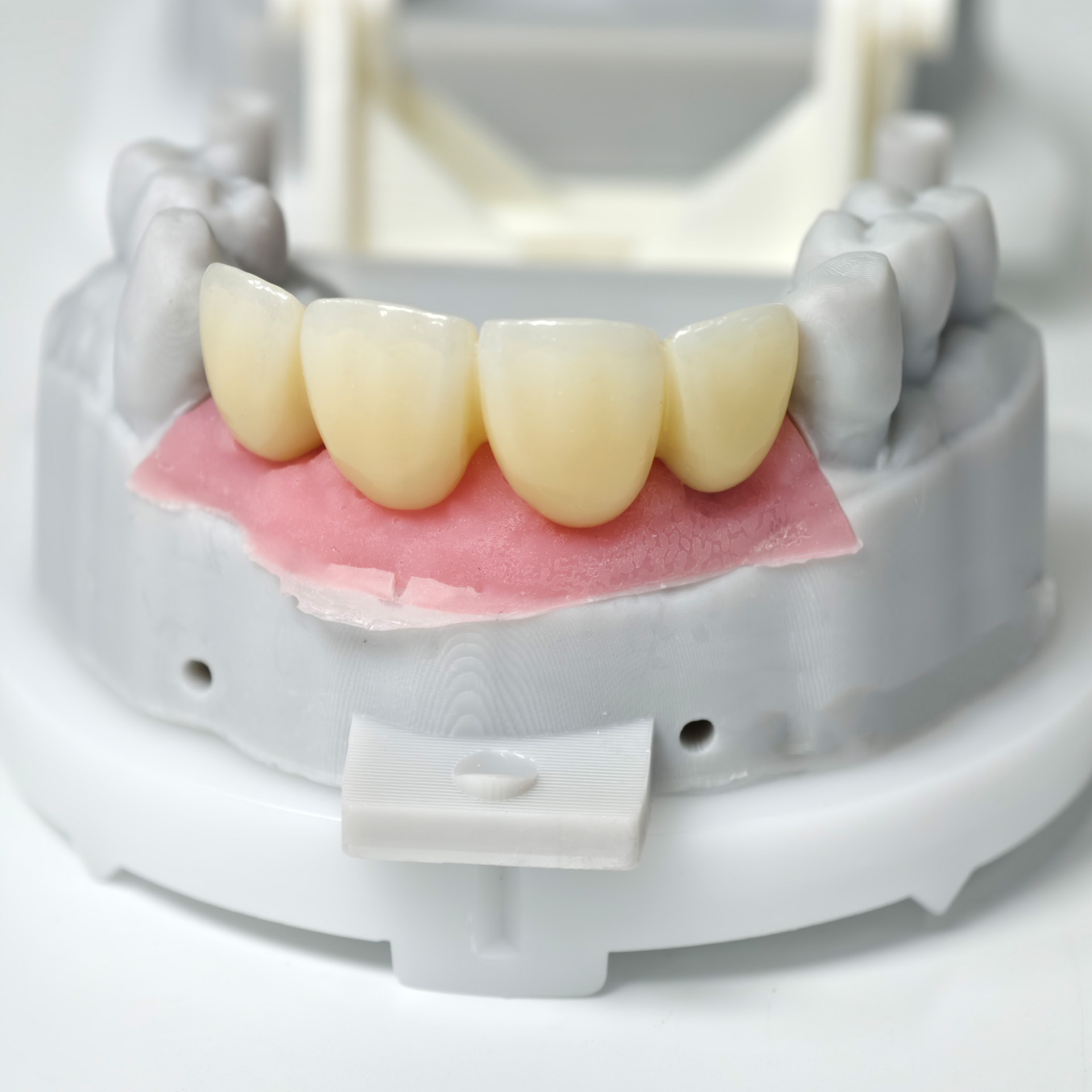 Zirconia bridge with screw ret