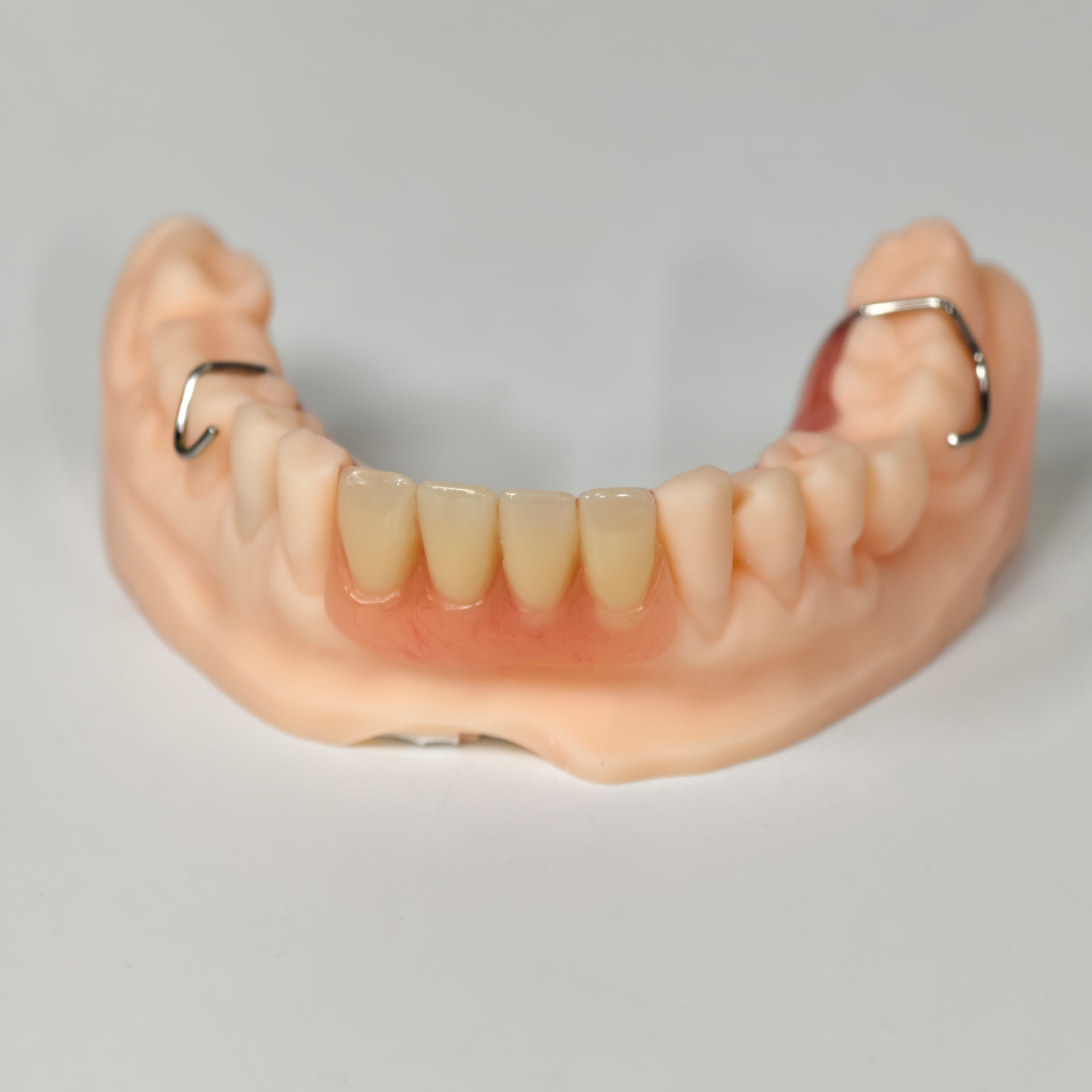 Metal clasp partial denture