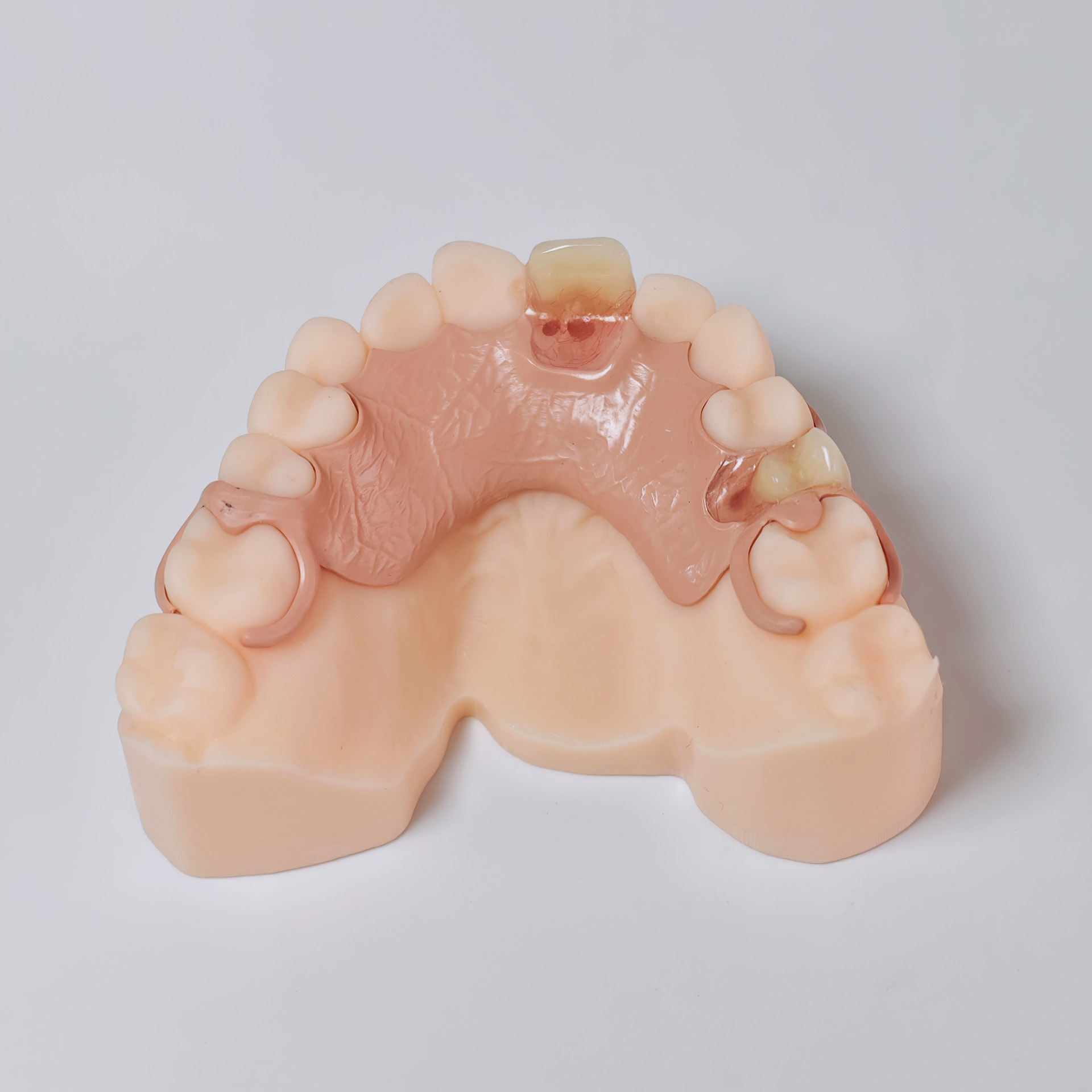 PEEK framework denture Metal f
