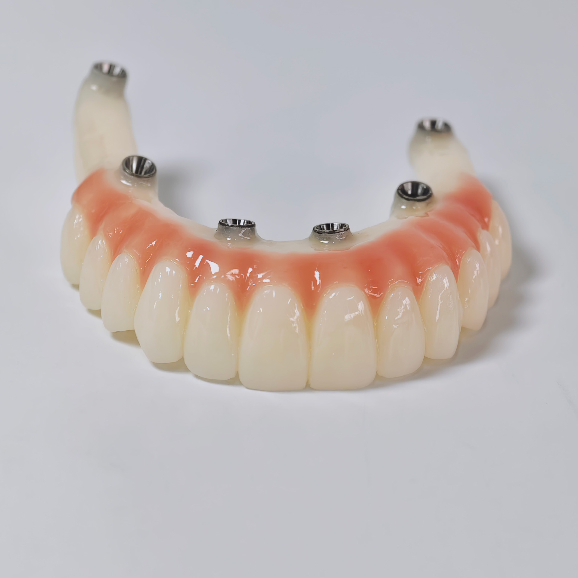 PMMA bridge with screw retaine