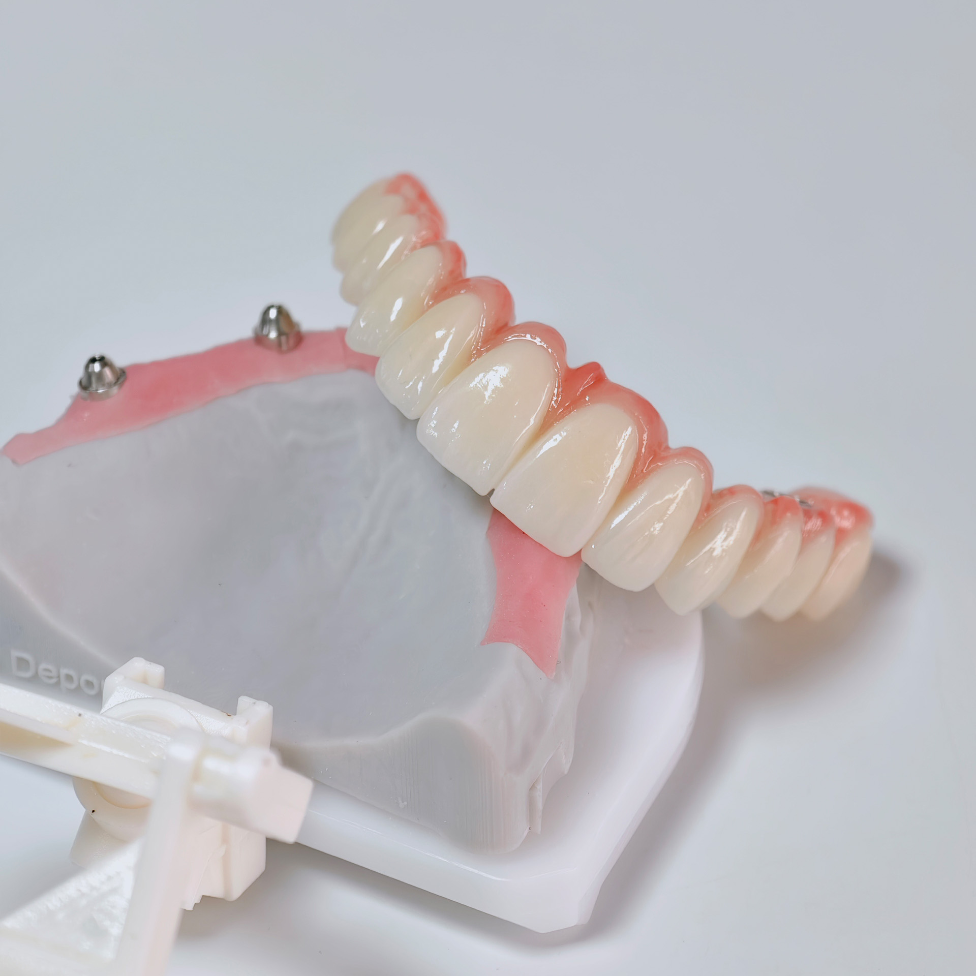 All on 6 zirconia bridge with 