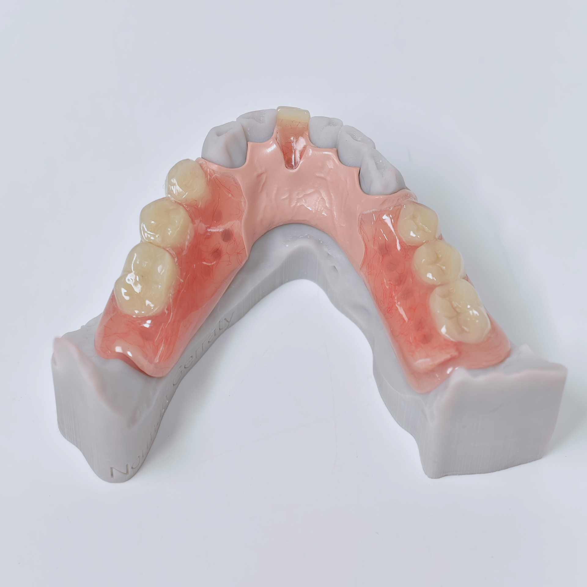 PEEK framework denture Metal f