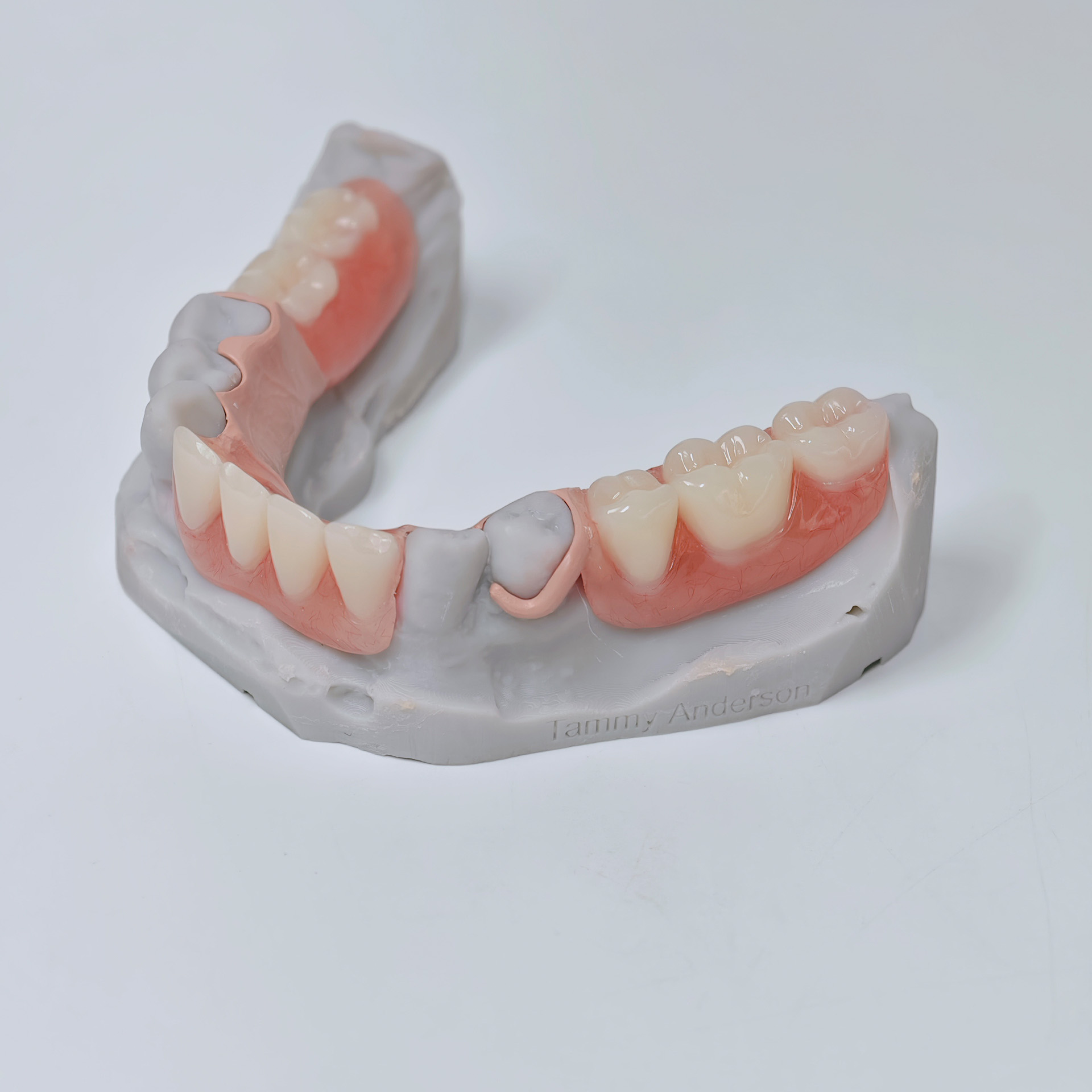 PEEK framework denture Metal f
