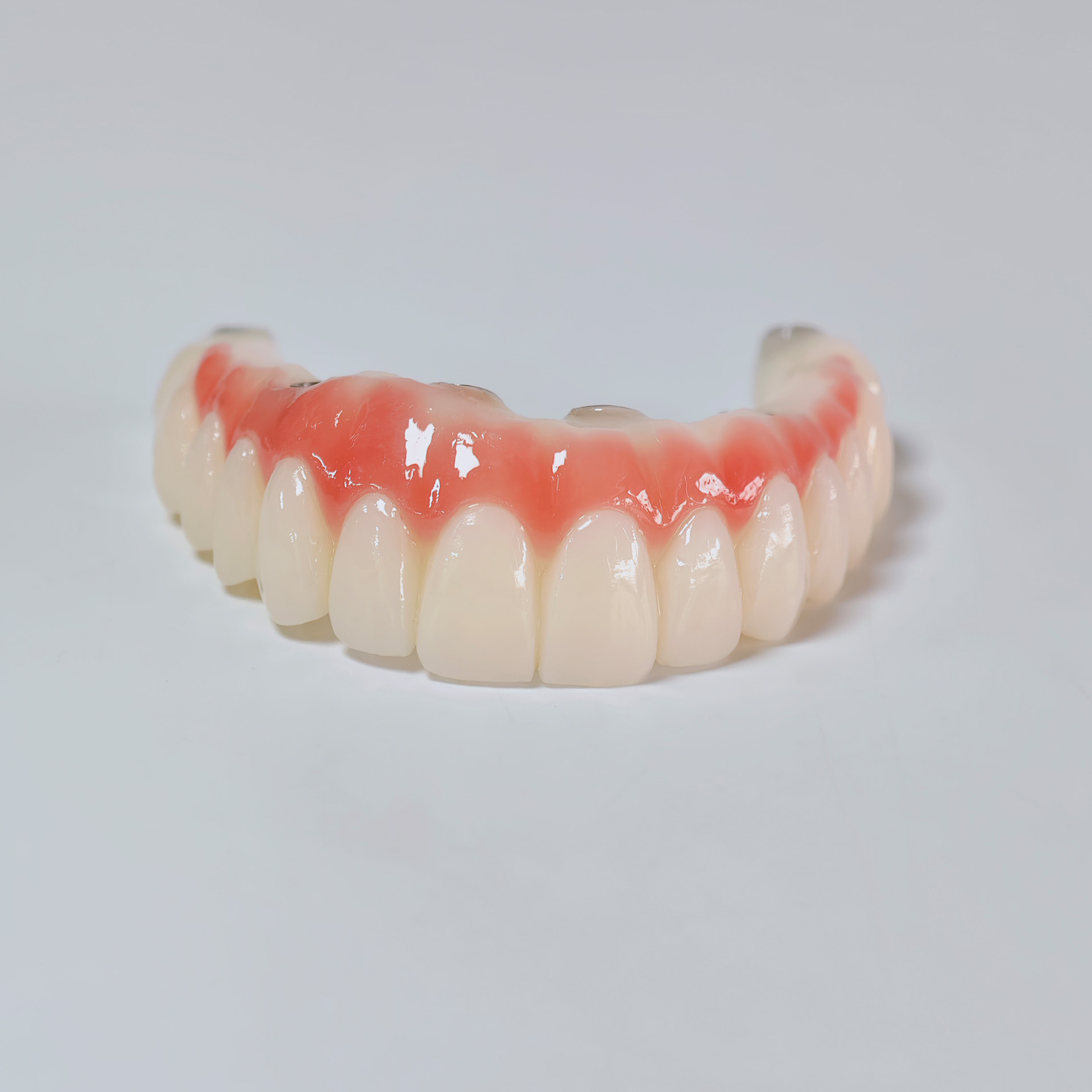 PMMA bridge with screw retaine