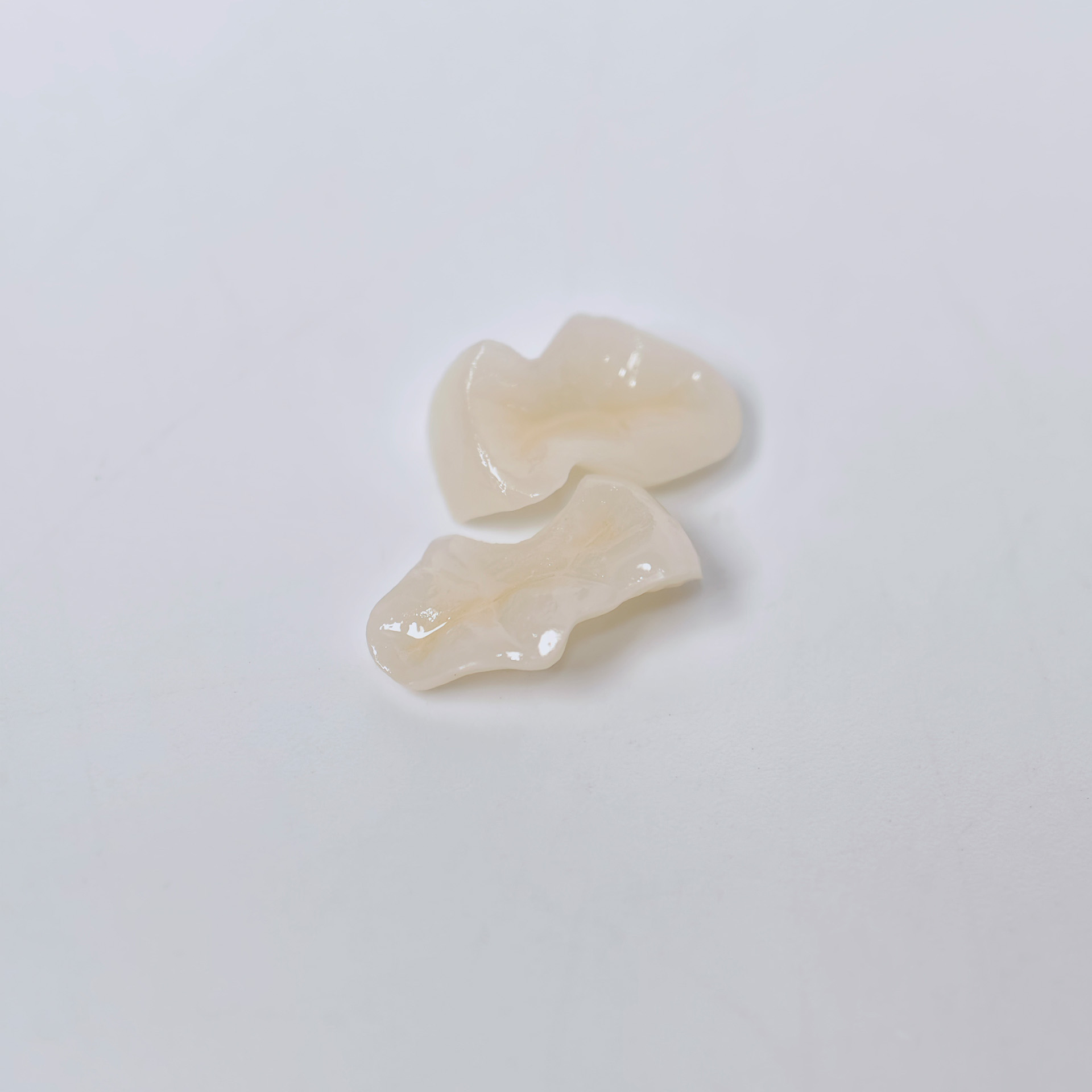 E.Max Inlay/Onlay