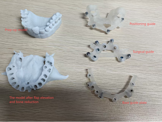 Full surgical guide plate, use