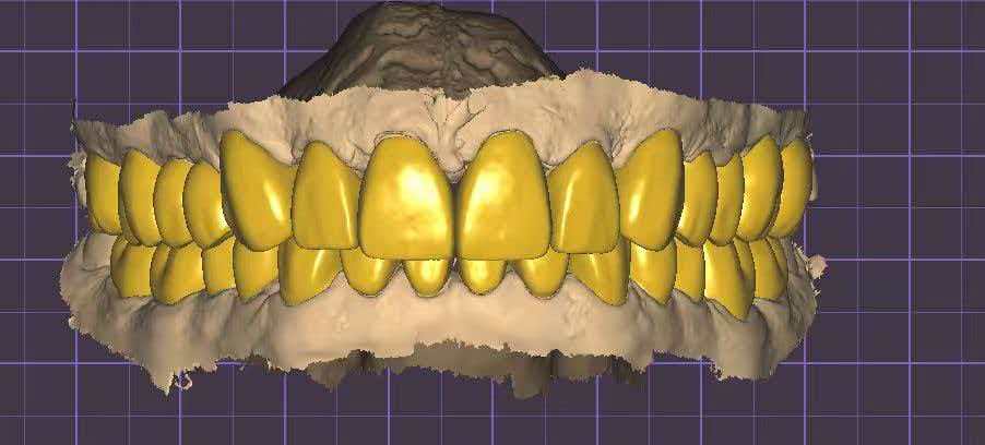 Upper and lower Smile Design