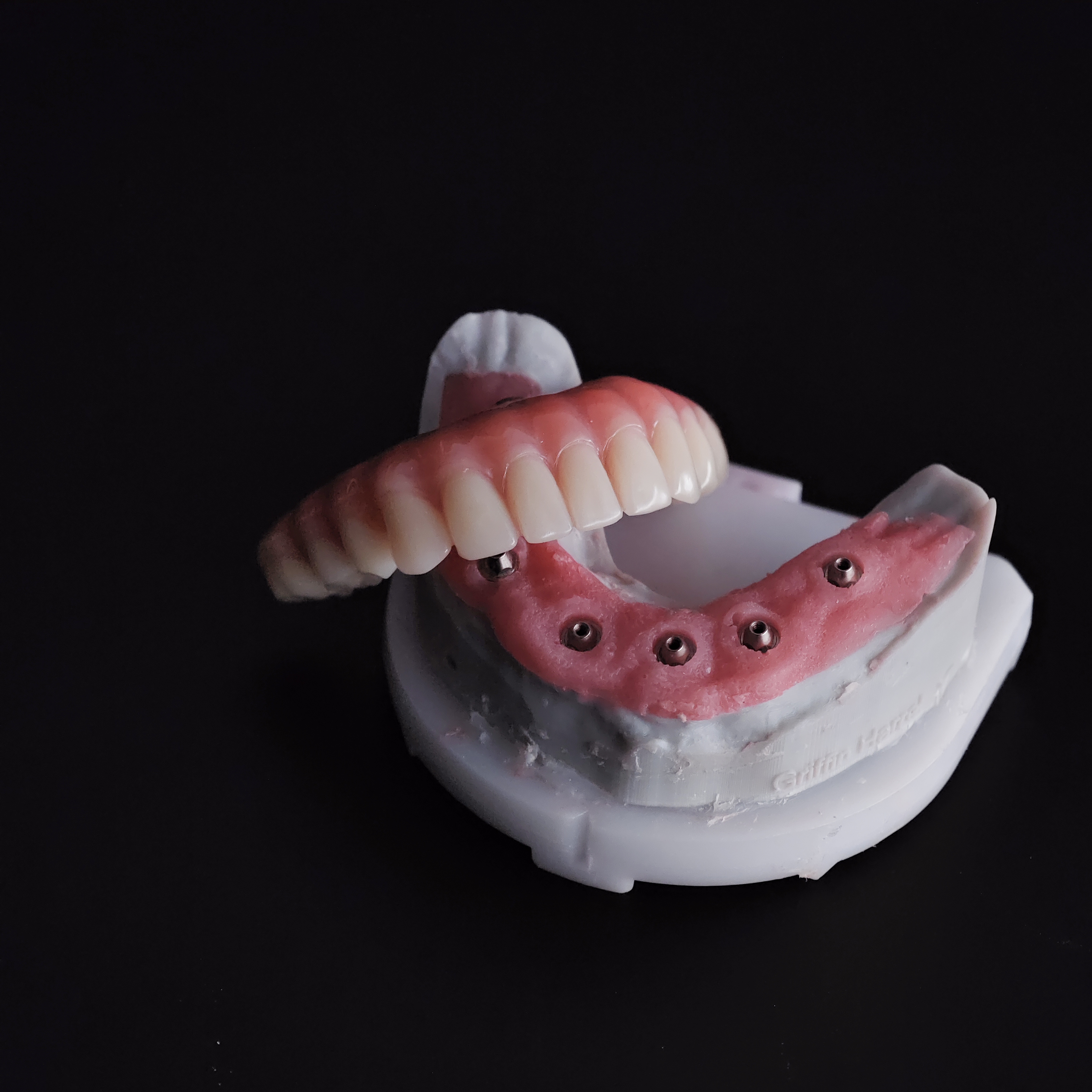 An acrylic denture with a tita