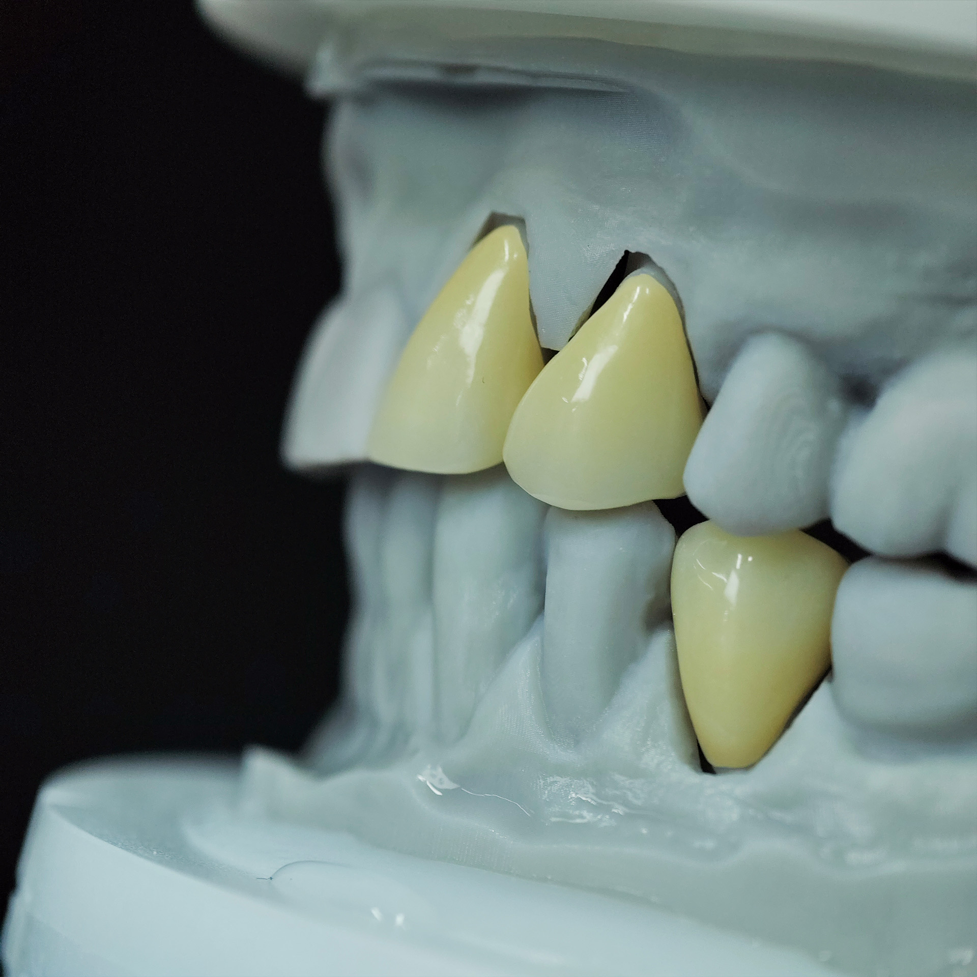 High - Strength Zirconia crown