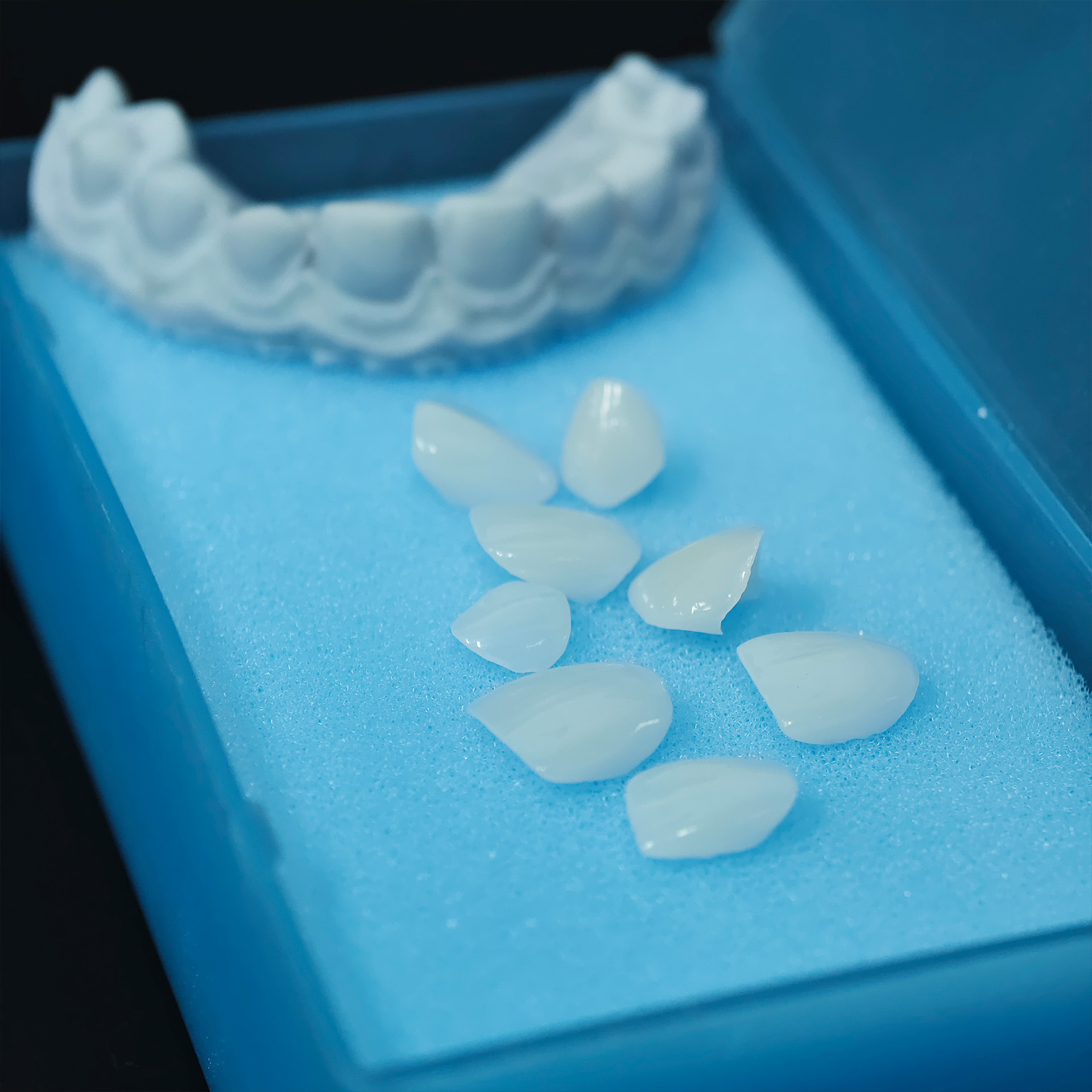 Ultra-thin emax veneer. High t