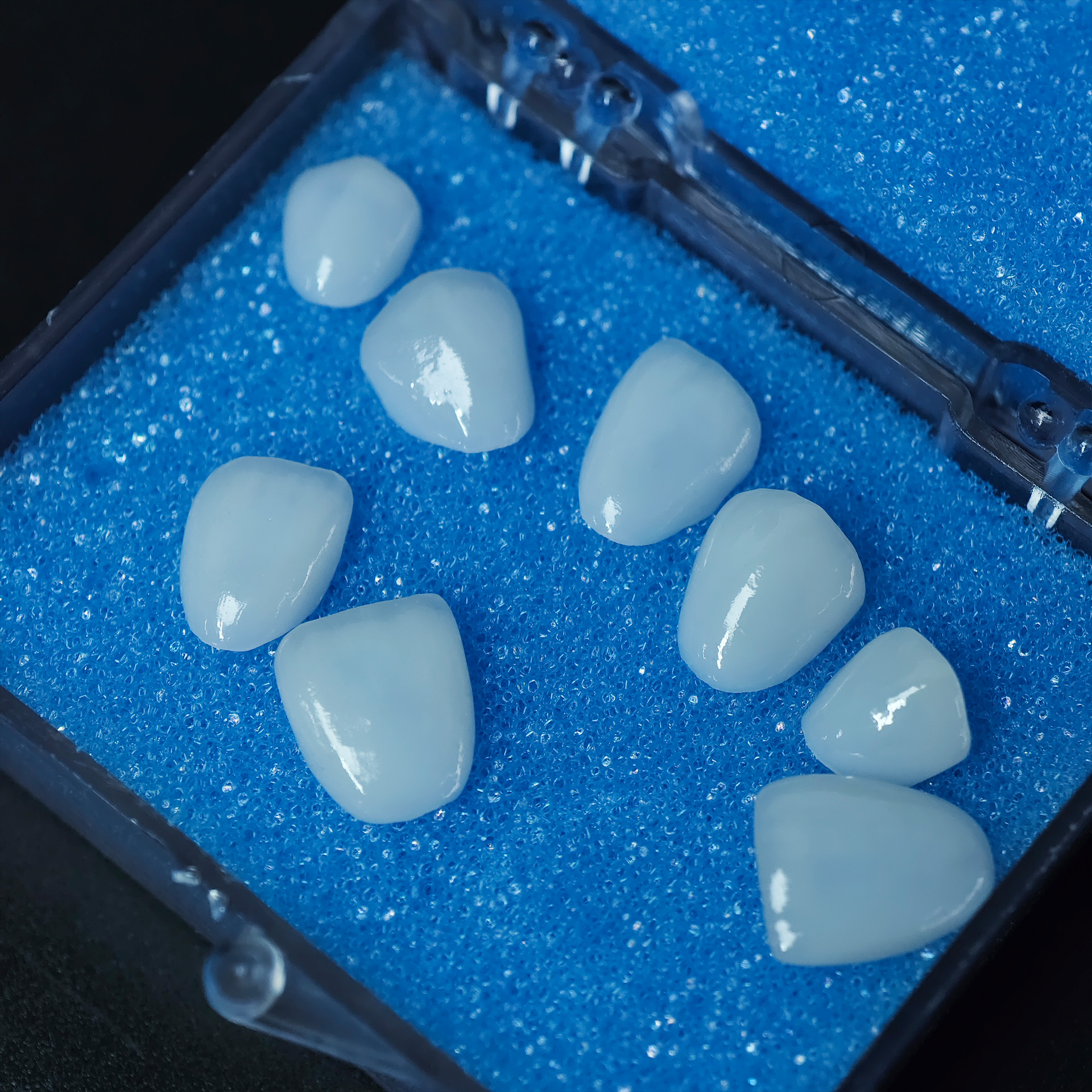 Ultra-thin emax veneer. High t