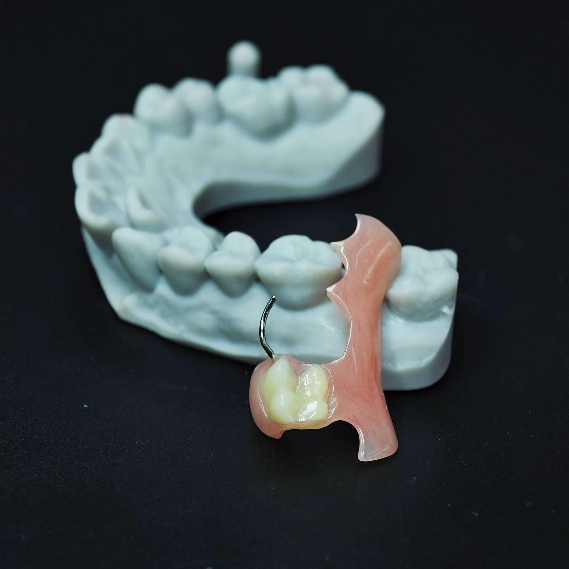 Metal clasp partial denture