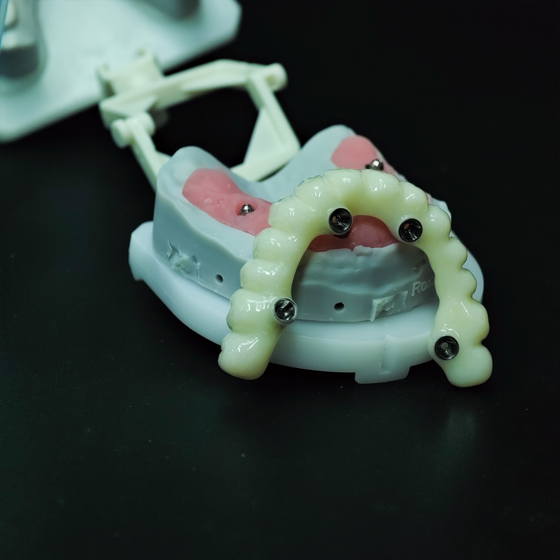 PMMA bridge with screw retaine