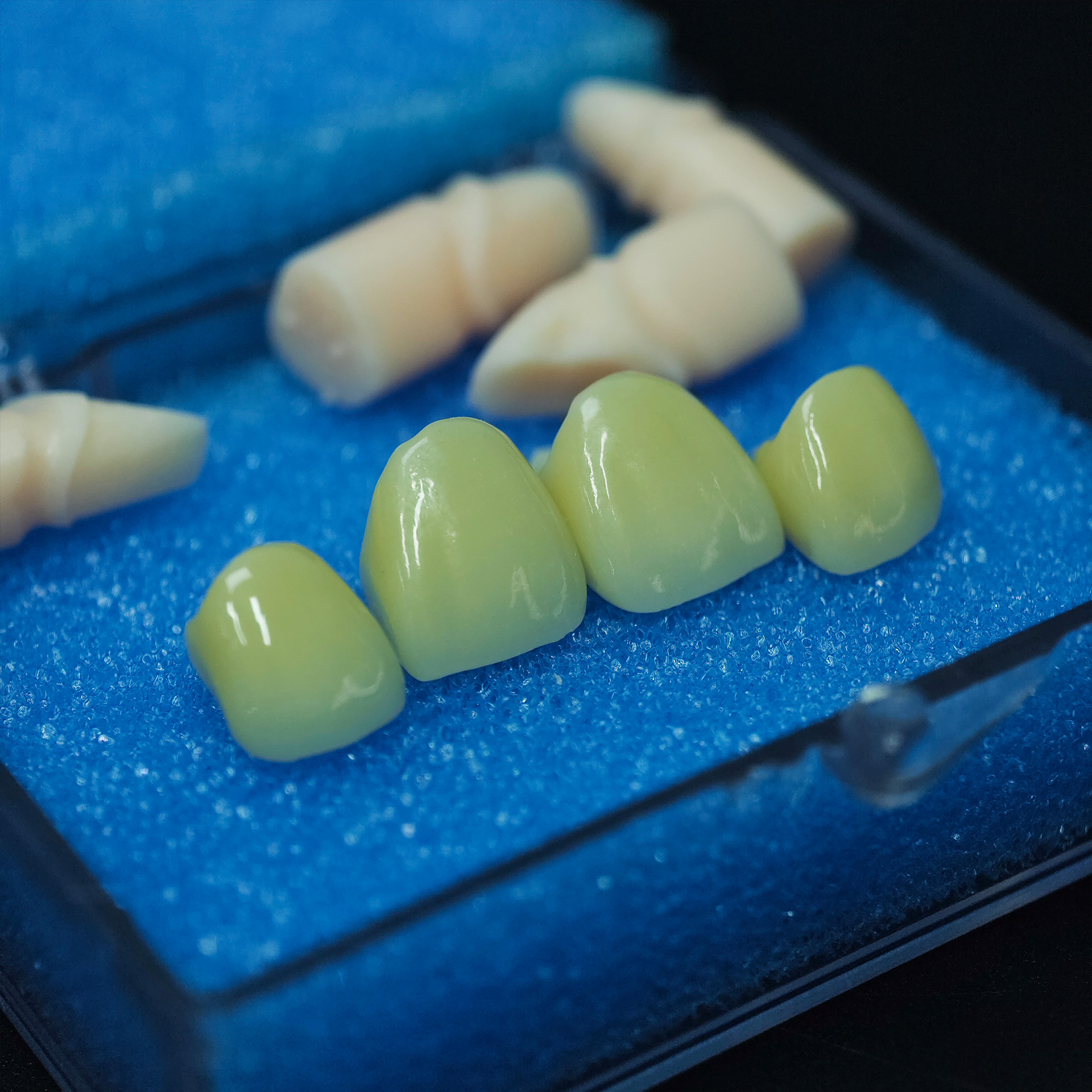 Aesthetic zirconia crowns(PFZ)
