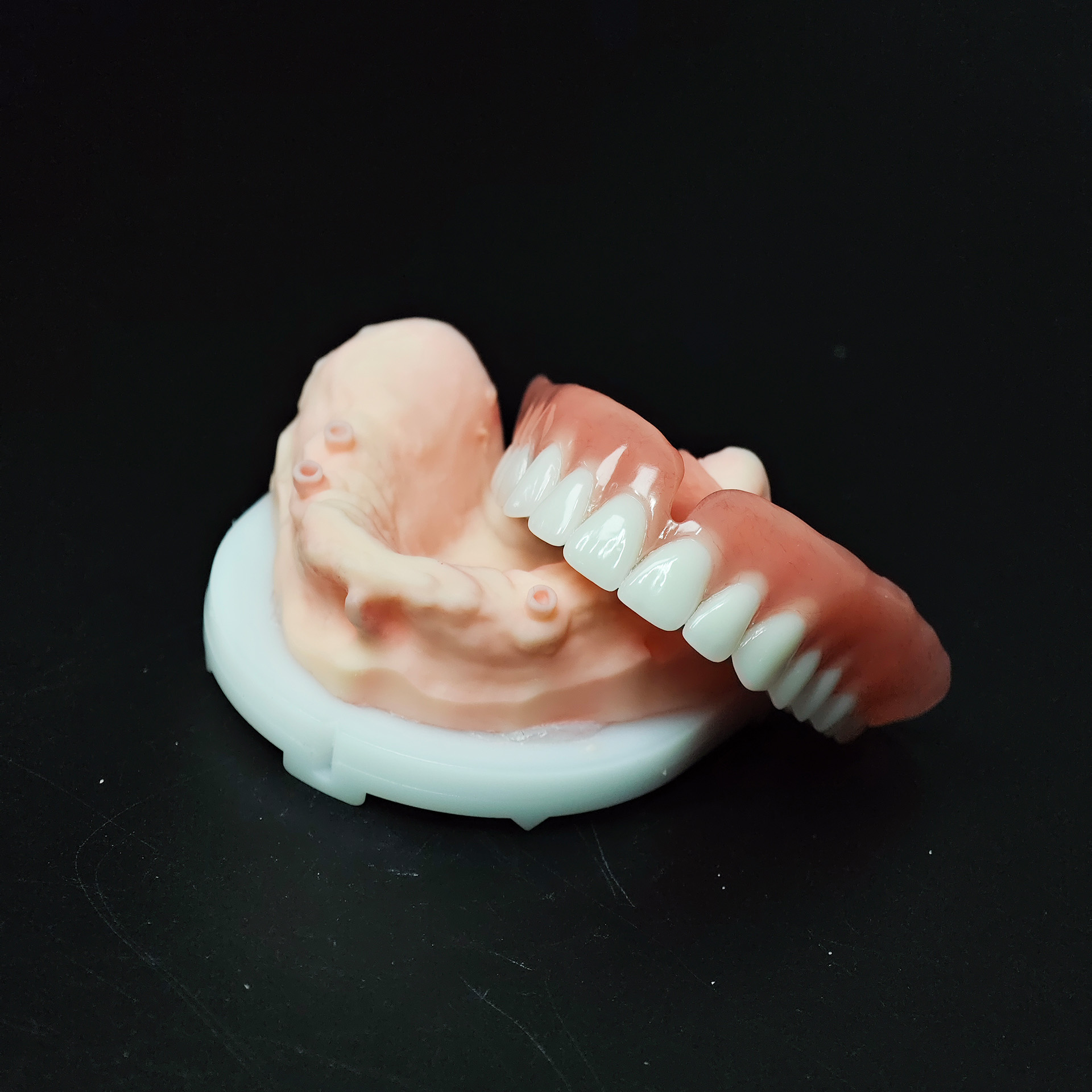 Locator Retained Implant Overd