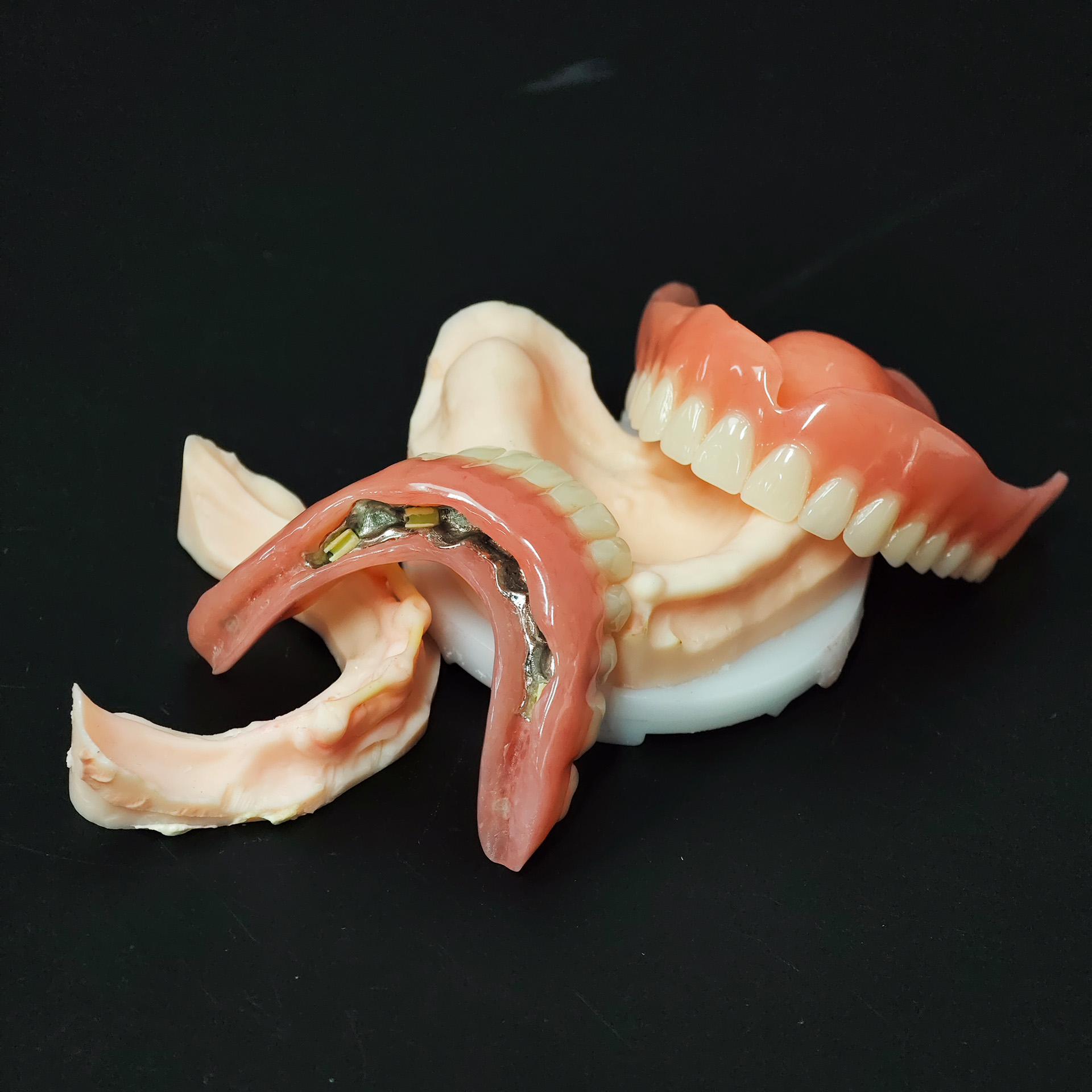 Snap‑On Overdenture with acryl